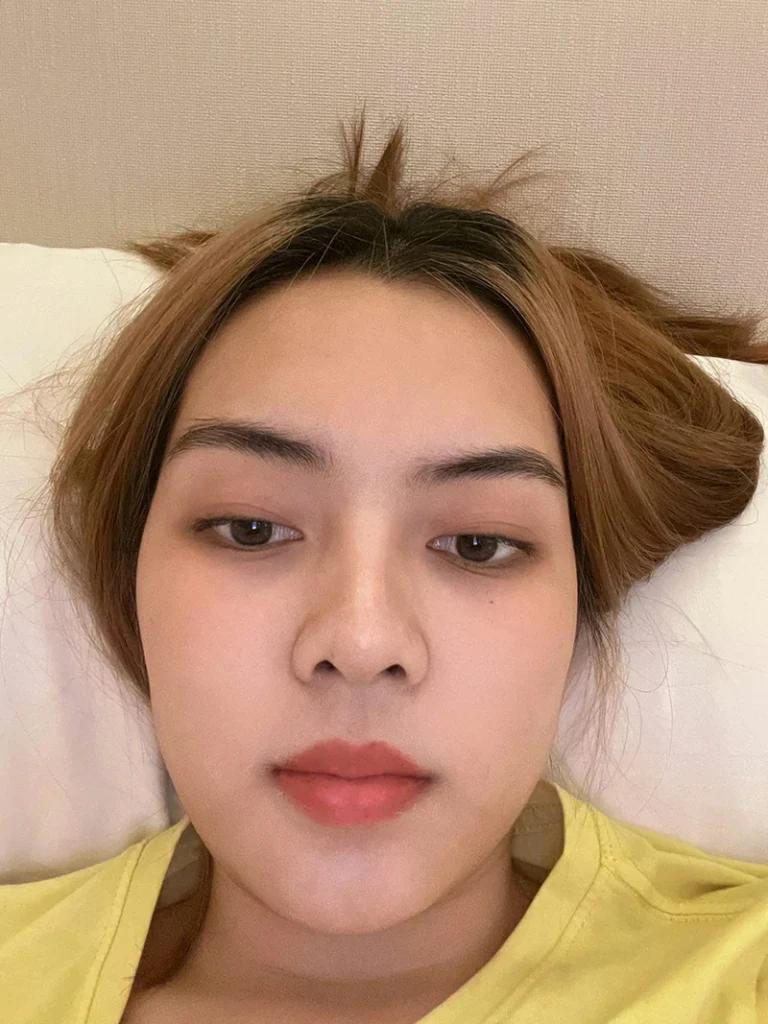อัพเดท 3 วัน แกกกกก เป็นไงปังมั้ยขนาดนอนถ่ายหน้ายังเล็กเลย หลังผ่าตัดกราม กล้ามเนื้อกราม 3 วัน