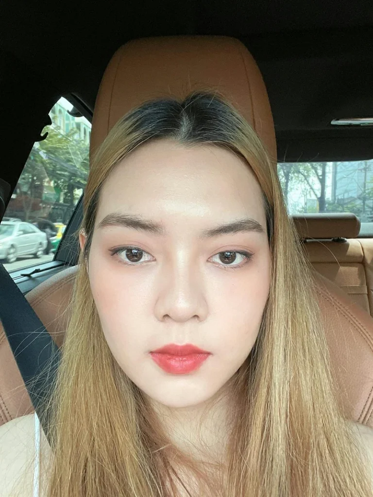 วันที่ 7 แต่งหน้าออกไปซ่าได้แล้ววว 7 วันหน้าเริ่มเข้าที่ยุบบวม