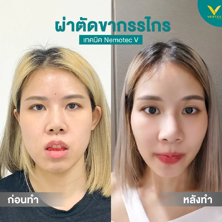 เทียบให้เห็นอีกทีใครไหวไปก่อนเลยค่ะ ทางนี้ไม่ไหว ภาพก่อนและหลังผ่าตัดขากรรไกรร แก้ปากอูม