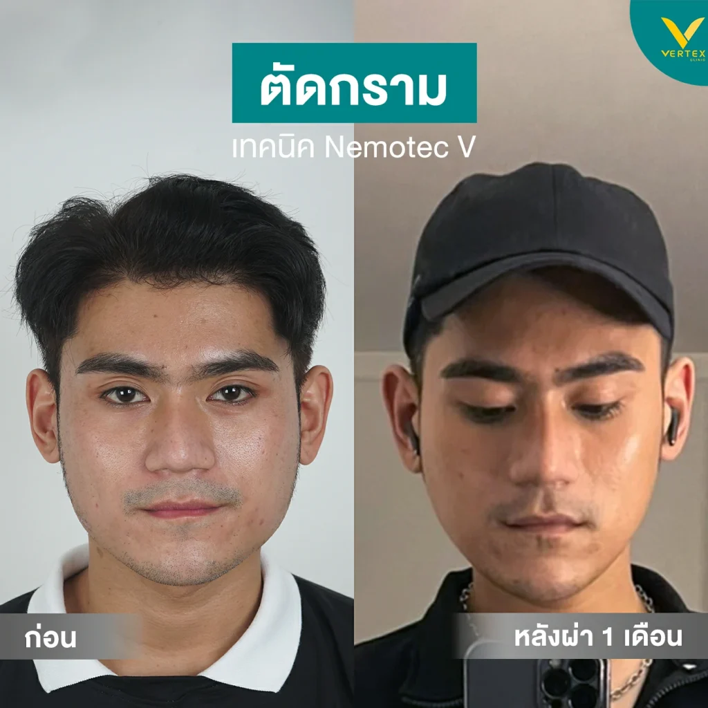 รีวิวตัดกราม 1 เดือน