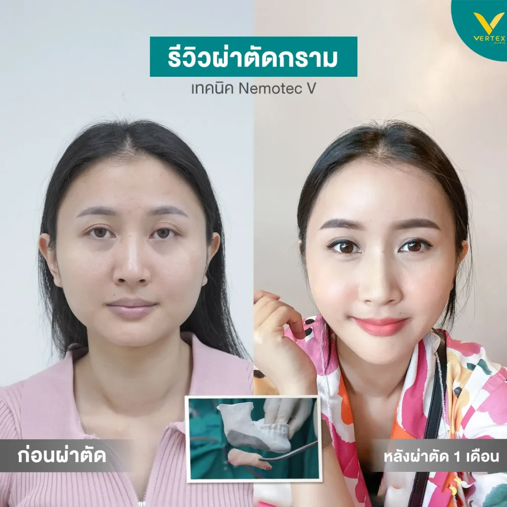 รีวิวตัดกราม