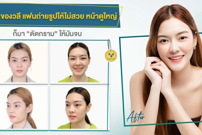 รีวิวตัดกรามครั้งนี้ เหตุเพราะแฟนถ่ายรูปไม่เคยถูกใจ เลยจัดชุดใหญ่ตัดกรามสะเลย