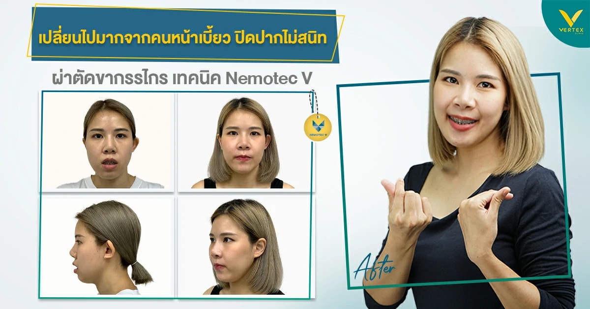 รีวิวผ่าตัดขากรรไกร แก้ปากอูม แบบละเอียดยิบ 12 วันไปงานได้แล้ว ไม่มีสายเดรน ไม่ต้องจัดฟันก่อน