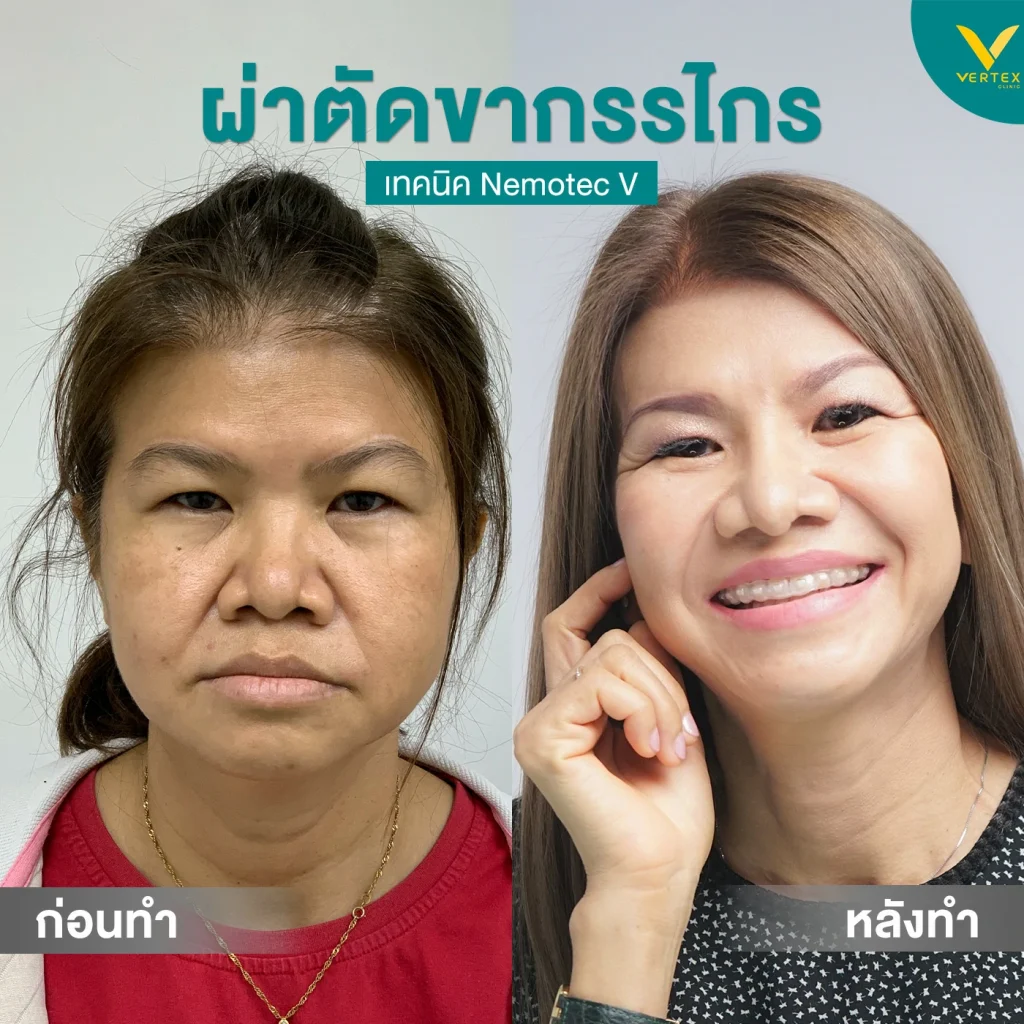 รีวิวขากรรไกร-คุณฐิติกานต์