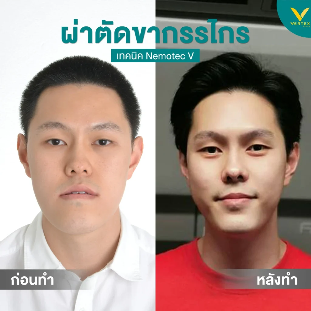 รีวิวขากรรไกร-ปิยวิทย์