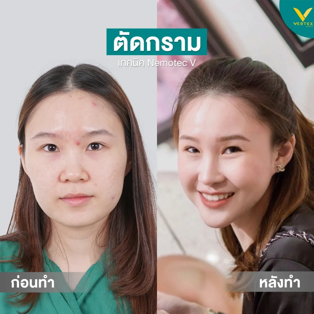 รีวิวตัดกราม+คาง คุณธนวดี[ตัดกาม]
