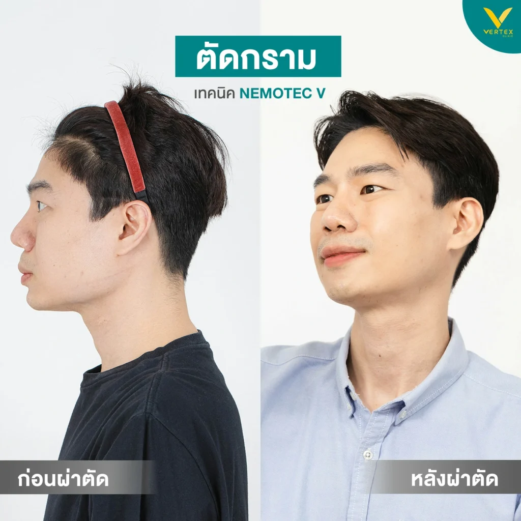 รีวิวตัดกราม