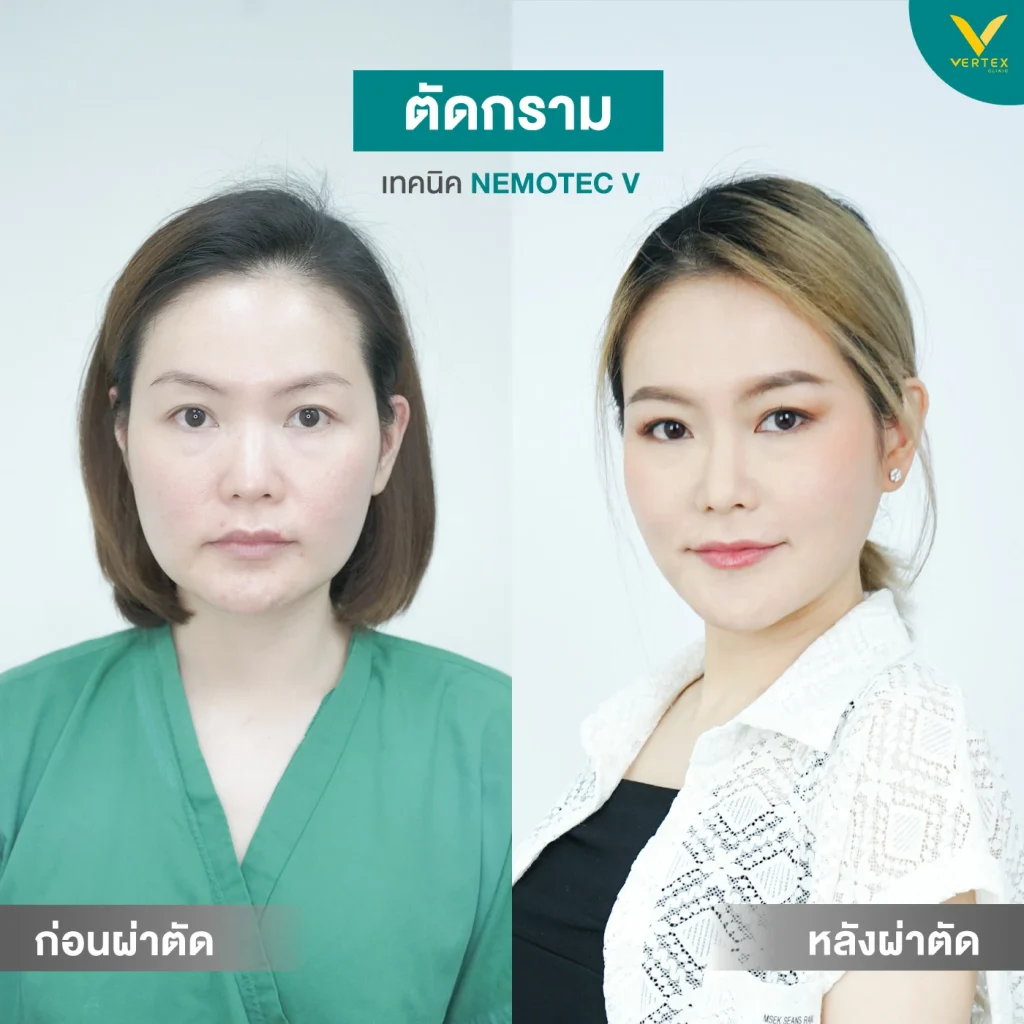 รีวิวตัดกราม