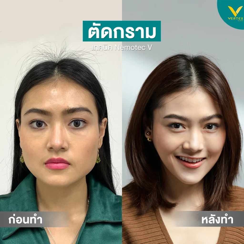 รีวิวตัดกราม+คาง คุณสุมนกาญจน์