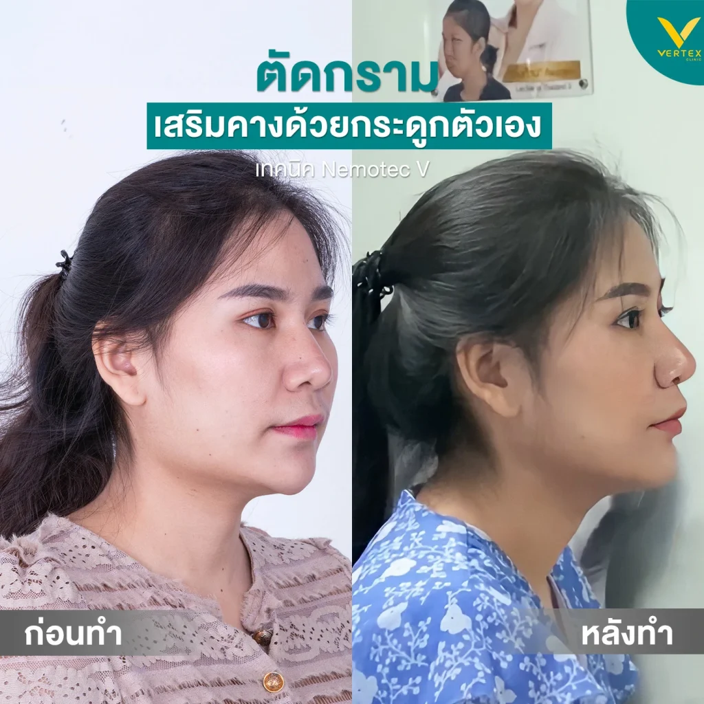 รีวิวตัดกราม+คาง อัชฎาพรรณ [กราม-คาง]