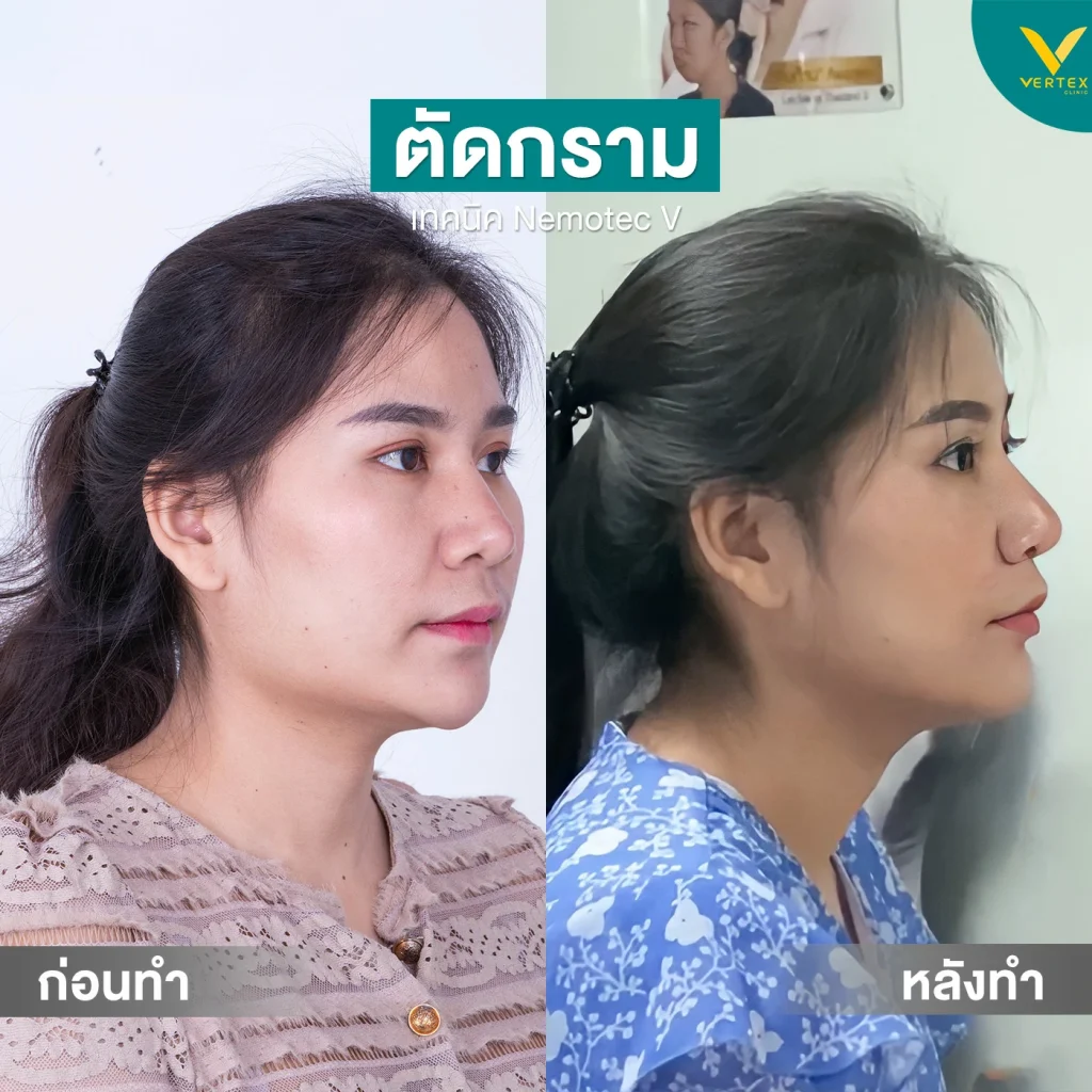 รีวิวตัดกราม+คาง อัชฎาพรรณ[ตัดกาม]