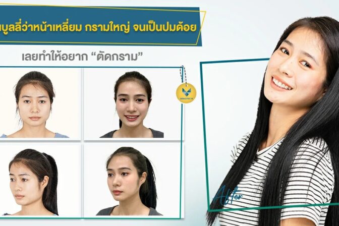 รีวิวตัดกราม ที่ได้โปรมาจากกิจกรรมกล่องสุ่ม คุ้มมากกก ใครไม่จองถือว่าพลาด!!