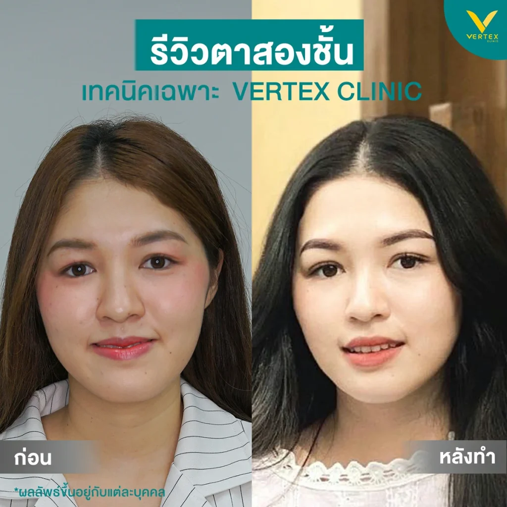 รีวิวตาสองชั้น