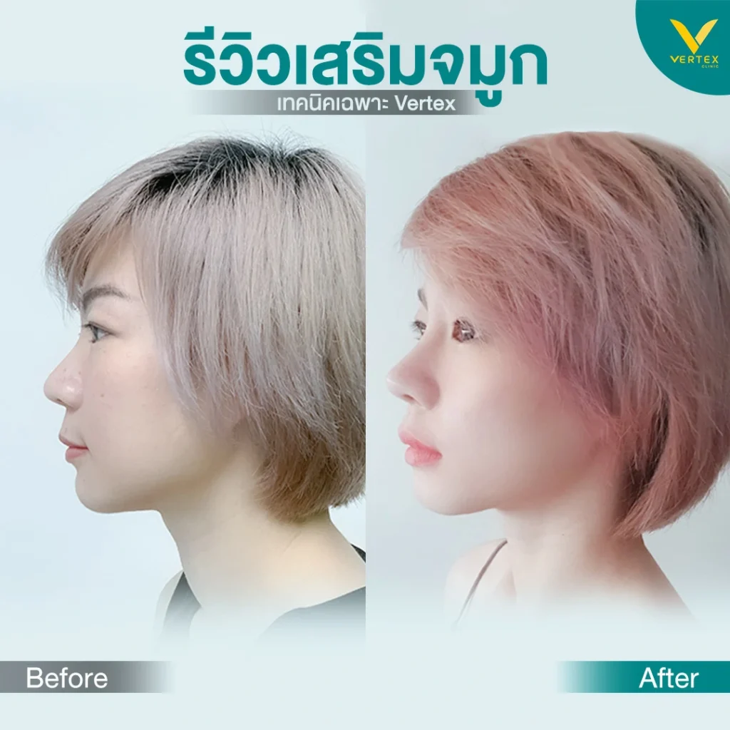 รีวิวเสริมจมูก คุณอลิสา