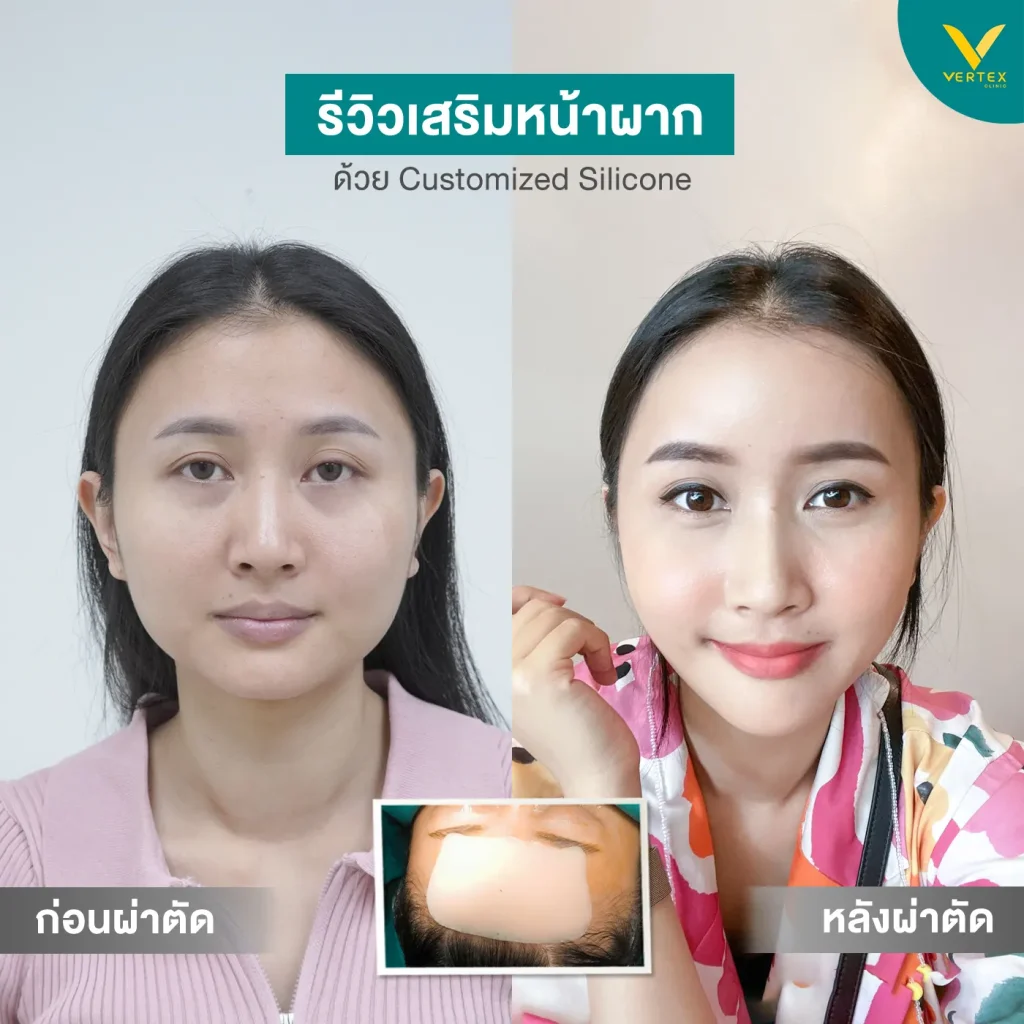 รีวิวเสริมหน้าผาก