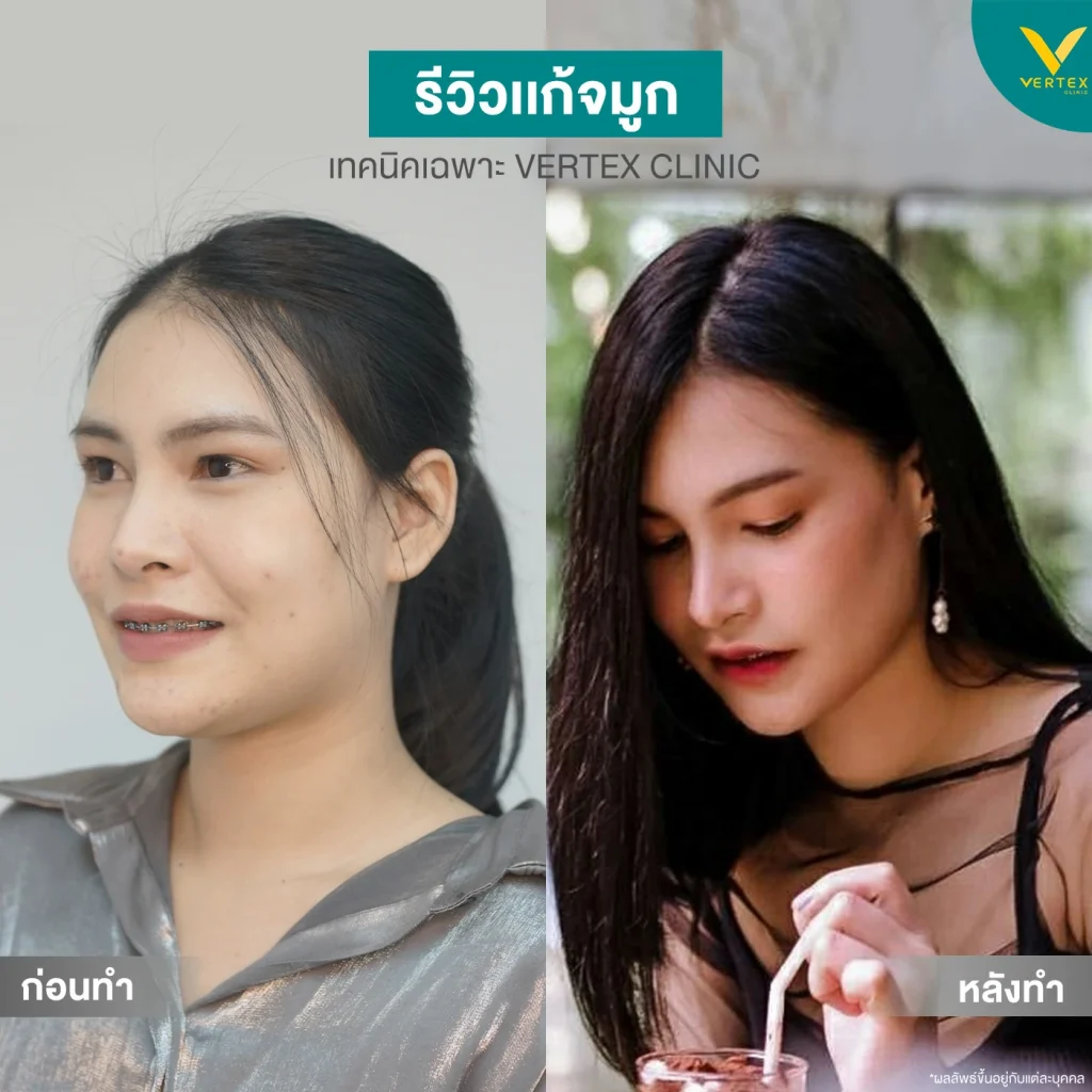 รีวิวแก้จมูกคุณโย