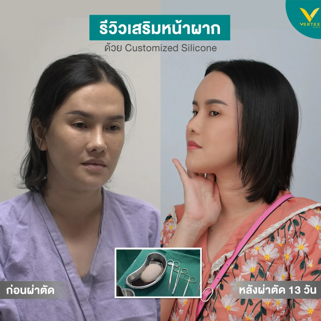 เสริมหน้าผากคุณรุ่งฤดี