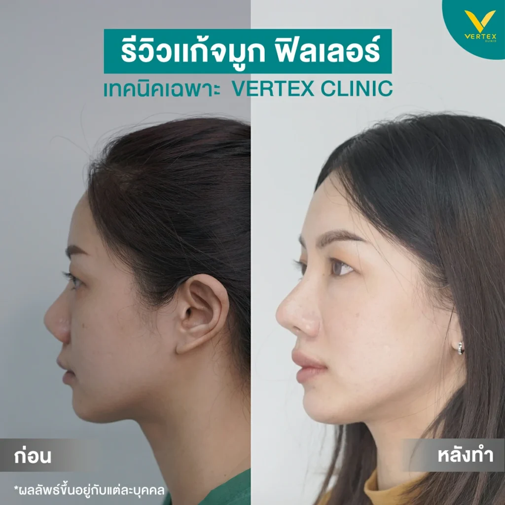 แก้จมูกฟิลเลอร์