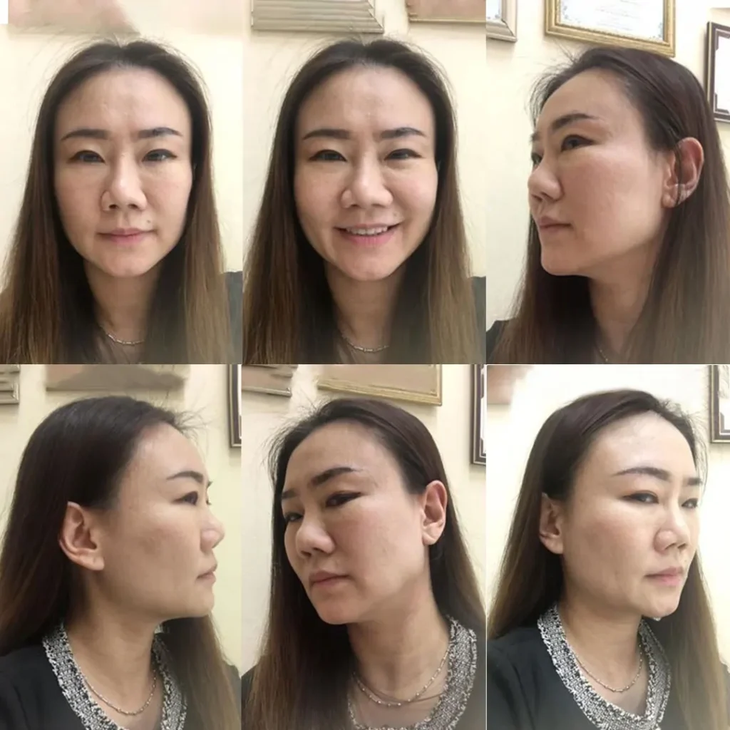 อันนี้เป็นรูปที่นิกส่งให้คุณหมอประเมินตอน CF สวย 1 นะคะ ตัดกราม