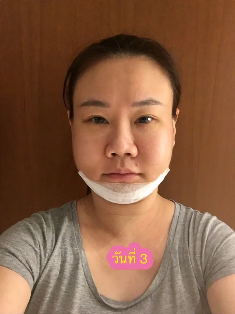 อันนี้วันที่ 3 จ้า รีวิวตัดกราม