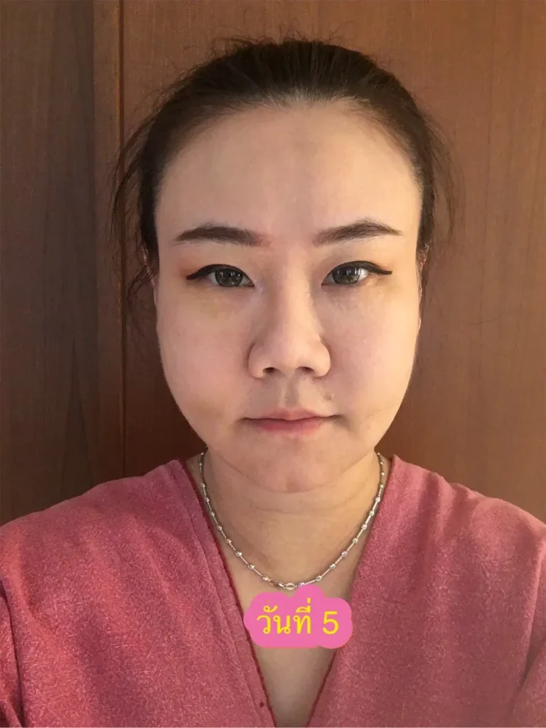 ยุบบวมแล้วแต่มีรอยช้ำขึ้นมาเล็กน้อย รีวิวตัดกราม