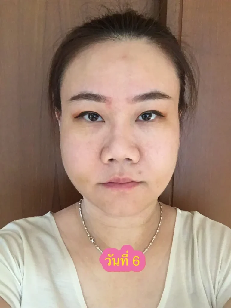 วันที่ 6 รอยช้ำยังคงมีอยู่ หน้าก็ยังตุ่ยๆอยู่ แต่แผลโอเคมากค่ะ รีวิวตัดกราม