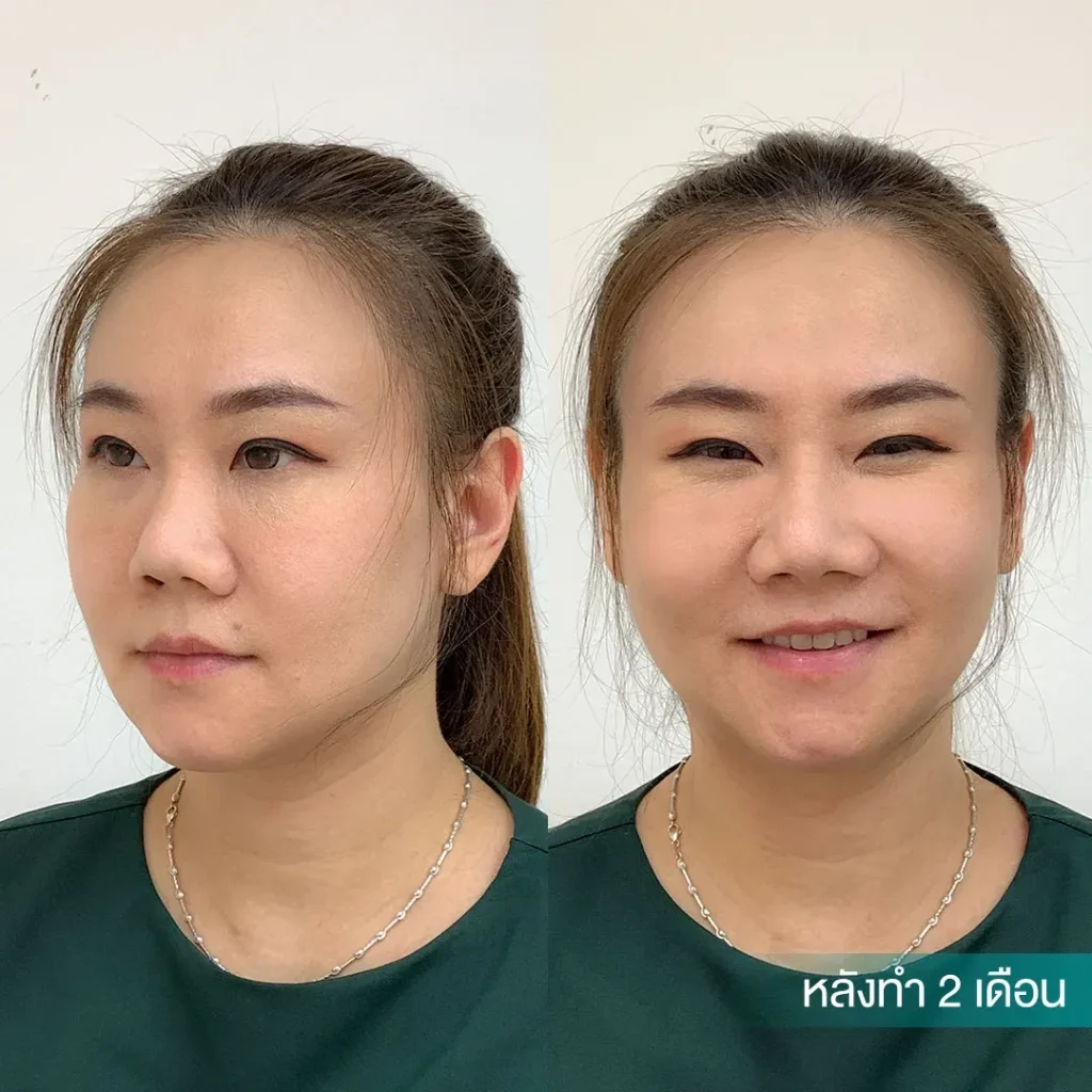 รีวิวตัดกราม