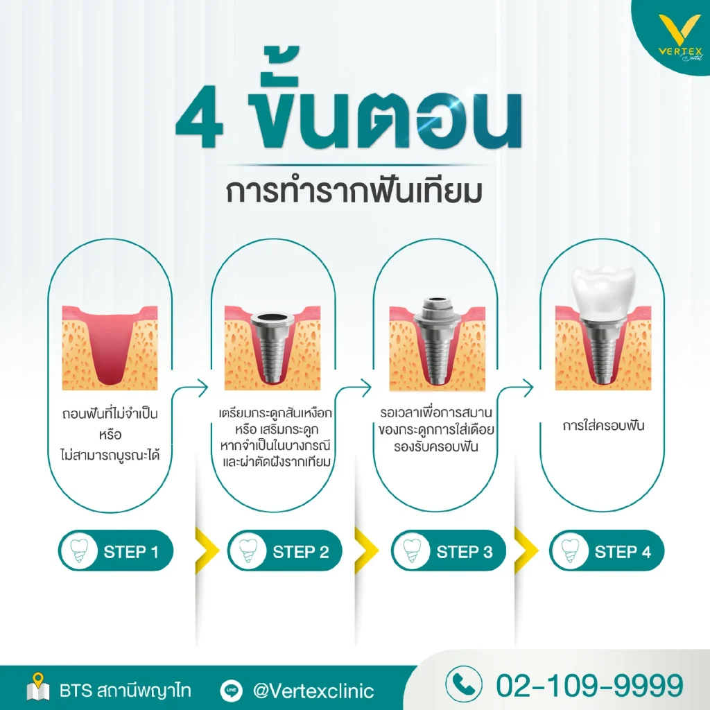 ขั้นตอนการทำรากฟันเทียม