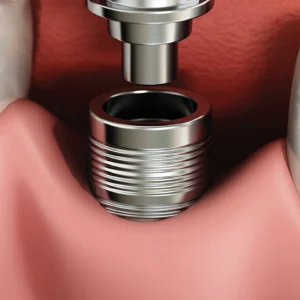 รากฟันเทียม (Dental implant)