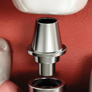 เดือยรับรองครอบฟัน (abutment)