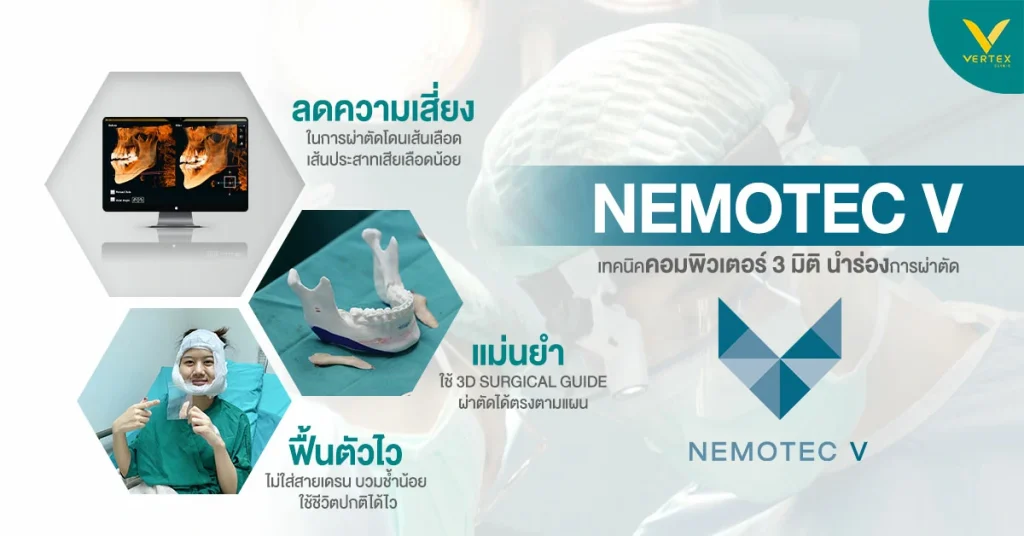 เทคนิค Nemotec V