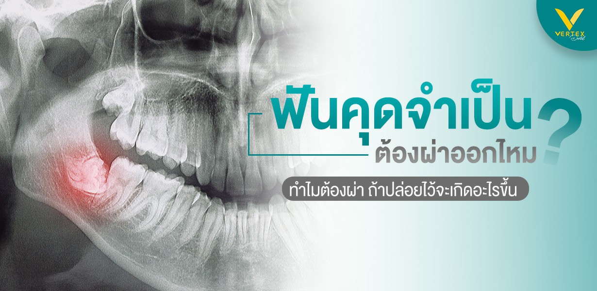 ฟันคุดจำเป็นต้องผ่าออกไหม