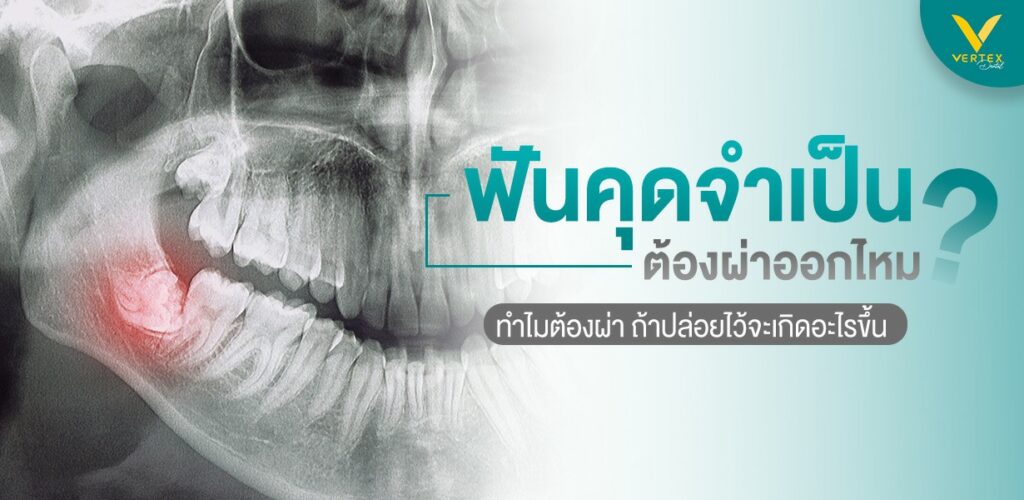 ฟันคุด