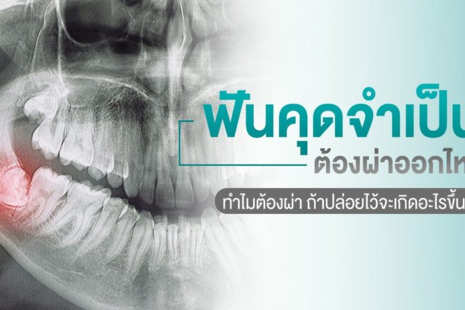 ฟันคุดจำเป็นต้องผ่าออกไหม?