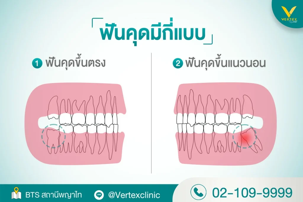 ฟันคุดมีกี่แบบ