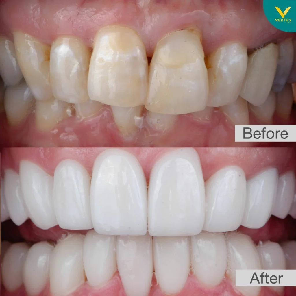 รีวิว-Veneer คอมโพสิต
