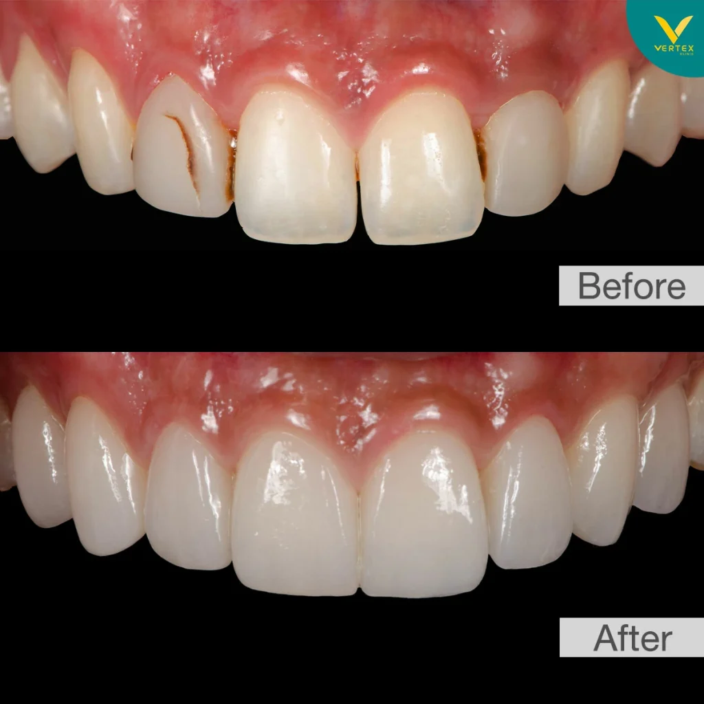 รีวิว-Veneer เซรามิก