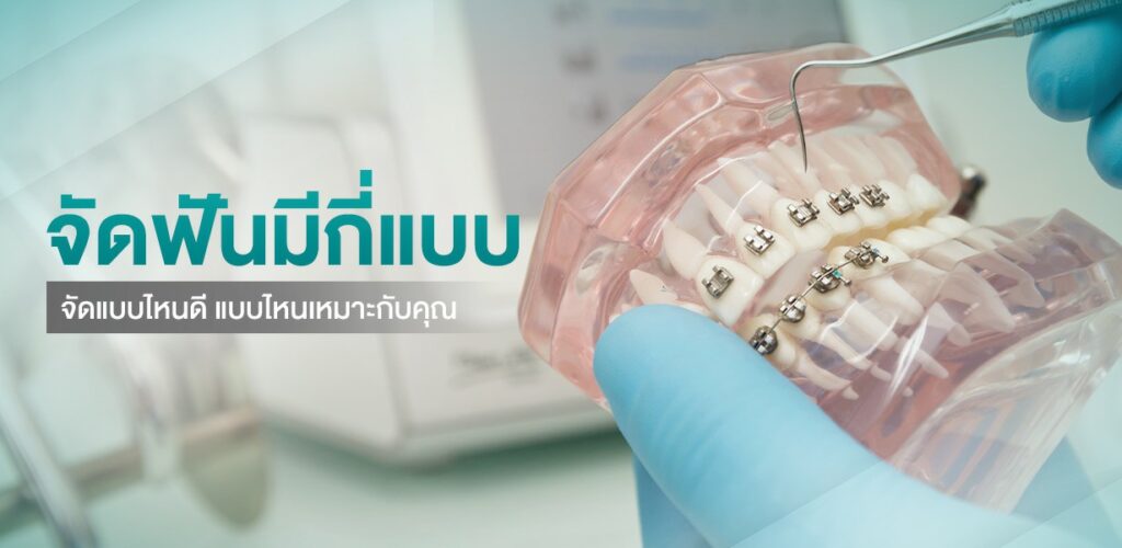 จัดฟัน