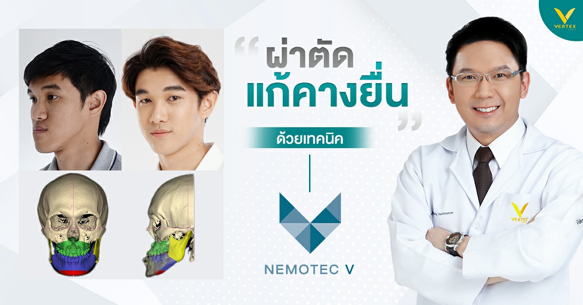 ศัลยกรรมแก้คางยื่น