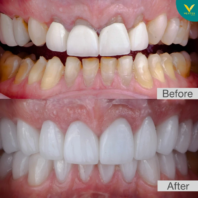 รีวิว Veneer
