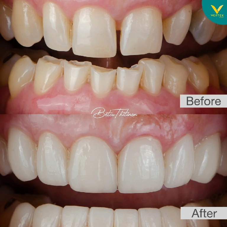 รีวิว Veneer