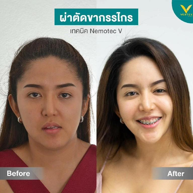 รีวิวผ่าตัดขากรรไกรแก้หน้าเบี้ยว 1