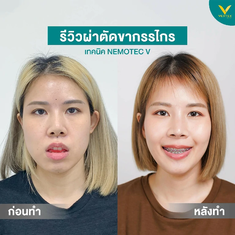 รีวิวผ่าตัดขากรรไกรแก้หน้าเบี้ยว 2