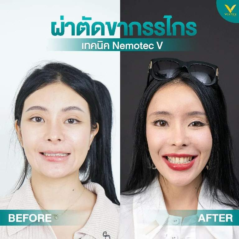 รีวิวผ่าตัดขากรรไกรแก้หน้าเบี้ยว 4