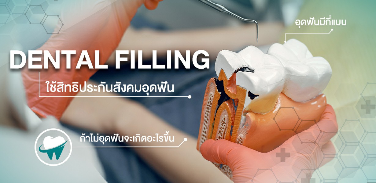 อุดฟัน