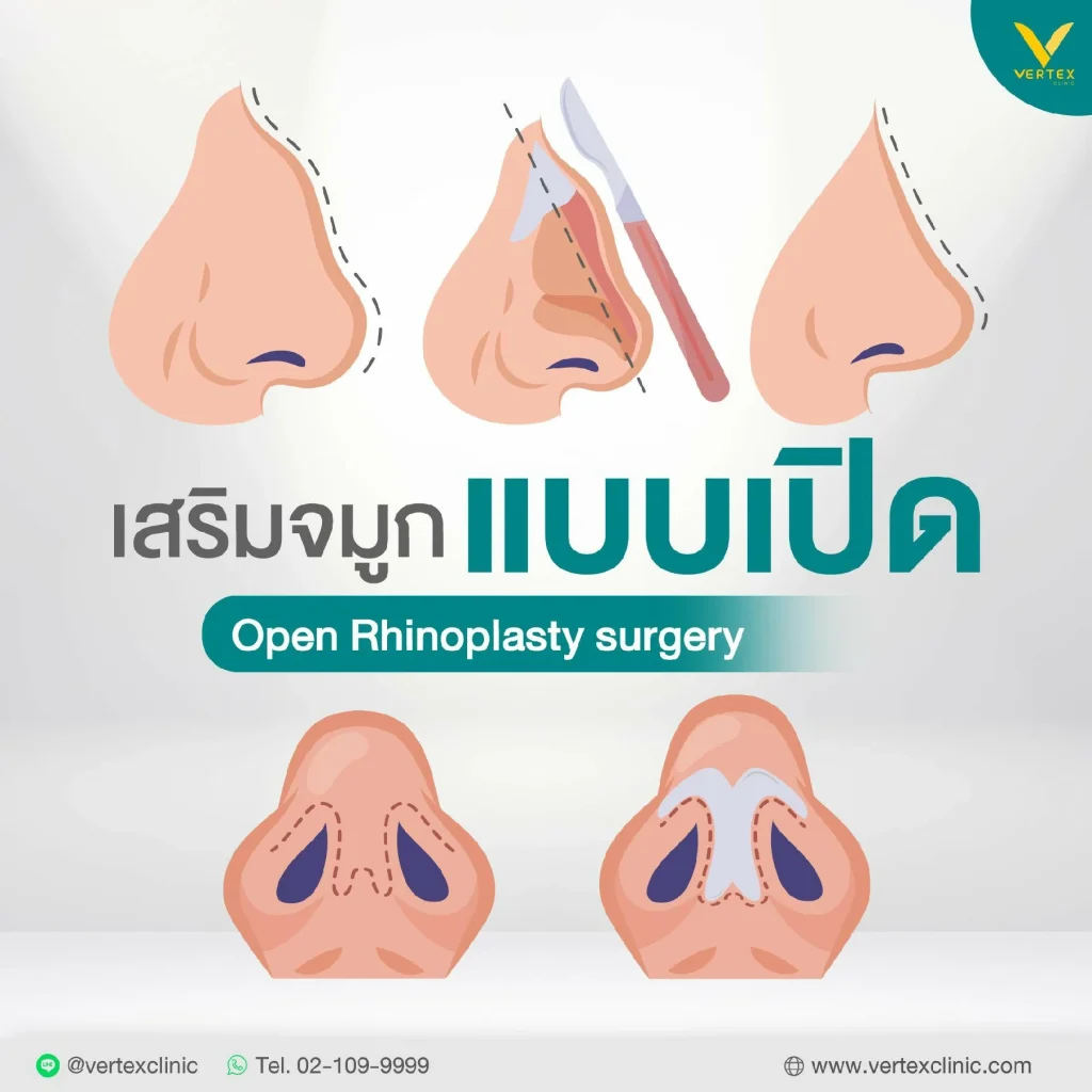 เสริมจมูกแบบเปิด Open Rhinoplasty surgery