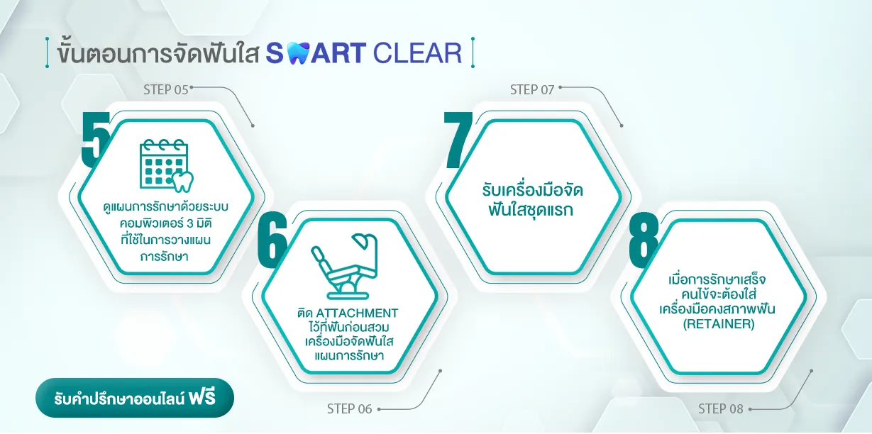 จัดฟันใส SMART CLEAR
