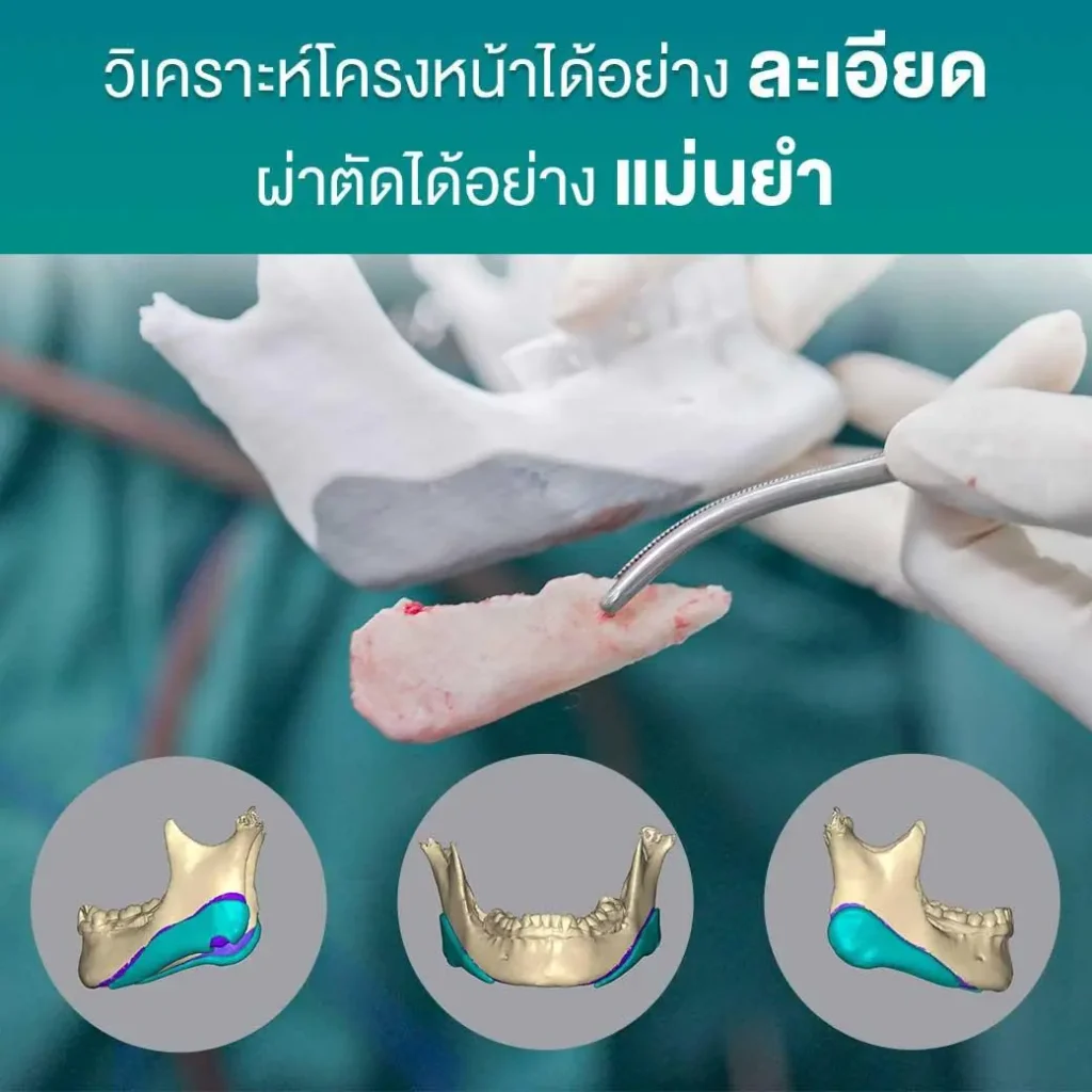ตัดกราม เหลากราม ศัลยกรรมกราม ด้วย เทคนิค Nemotec V ตัดกราม เหลากราม ศัลยกรรมกราม ด้วย เทคนิค Nemotec V