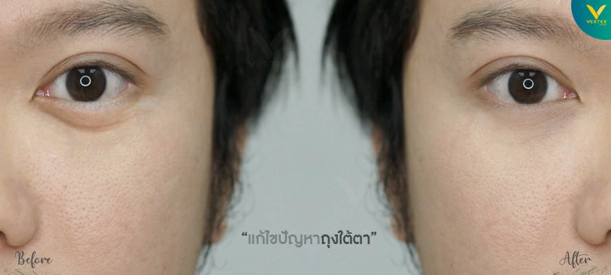 ผ่าตัดถุงใต้ตา