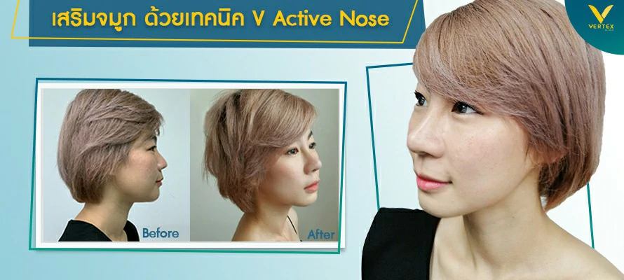 รีวิวเสริมจมูก